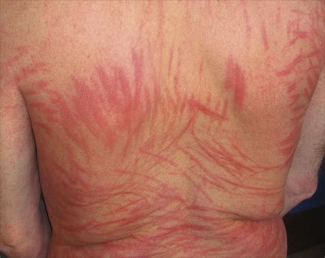 Shiitake Dermatitis Diagnosed After Years Dermatology Jama