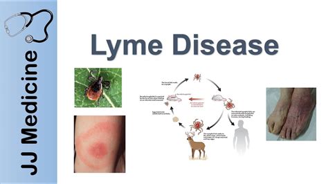 Lyme Disease Pathophysiology Signs And Treatment Youtube