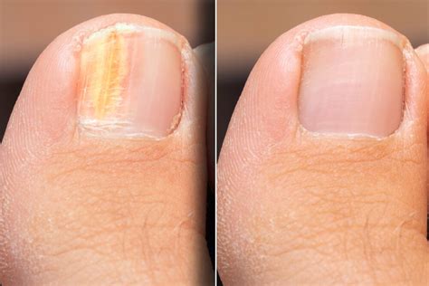 Causes And Treatments For Nail Fungus Onychomycosis Step To Health