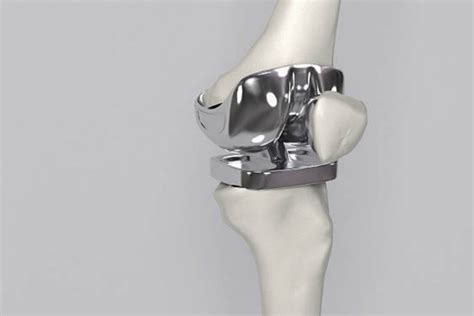 Prótese no Jeolho: Dúvidas - Dr Felipe Scofano