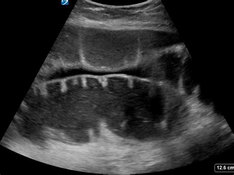 Bowel Obstruction Critical Care Sonography