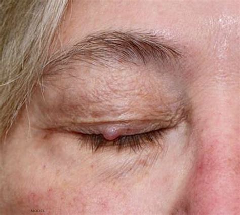 Eyelid Lumps And Bumps Removal Chicago Oculofacial