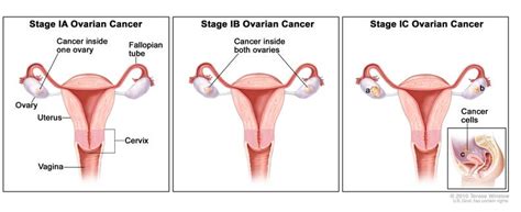 Removal Of Ovaries Fallopian Tubes Wrong Anticancer Option For Most