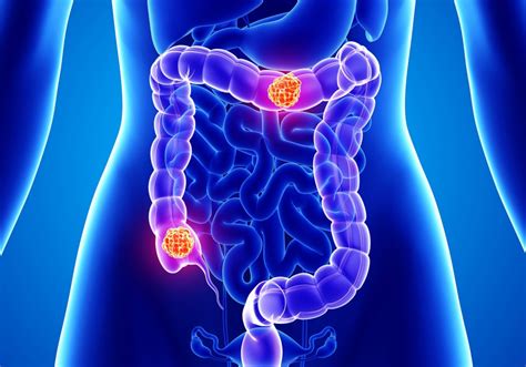 Colorectal Cancer Mortality Rates Increasing In Younger White Adults