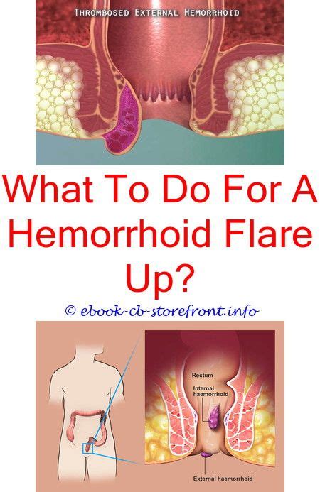 If you or the other side want to ask the court to do something in a case, you must ask in written court papers called a motion or an order to show. 16+ Wonderful Hemorrhoids Simple Ideas