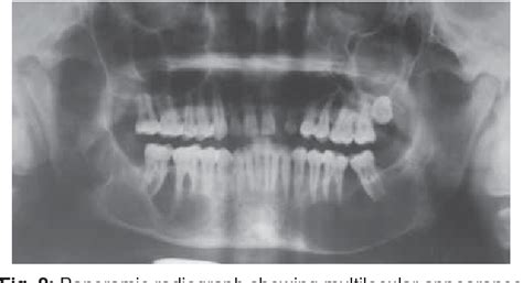 Figure 2 From Multiple Keratocysts Of The Mandible In Association With