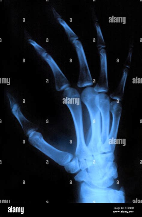 hand röntgenbild hände radiologie röntgenbilder röntgen röntgen stockfotografie alamy