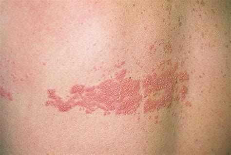 Shingles Rash Pictures Sexy Fucking Images Hot Sex Picture