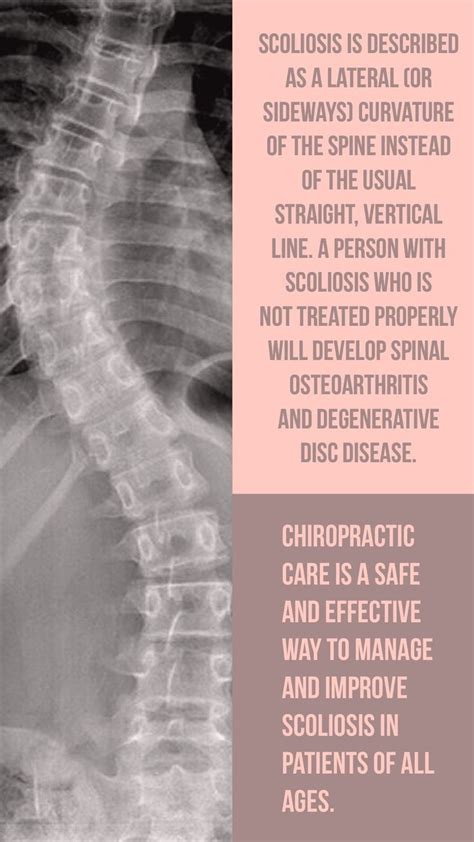 Chiropractic Care For Scoliosis Toexplain