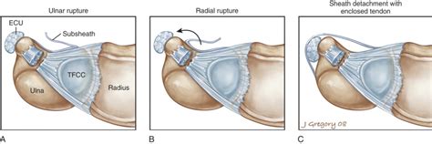 Incompetence of the ecu subsheath permits subluxation or dislocation of the ecu tendon out of the ulnar groove of the ulna extensor carpi ulnaris (ecu) subluxation occurs when the separate subsheath of the sixth dorsal compartment is torn or attenuated. Traumatic Extensor Carpi Ulnaris Disruption: Subluxation ...