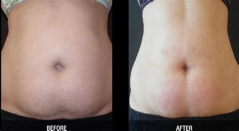 Velashape Before And After Abdomen