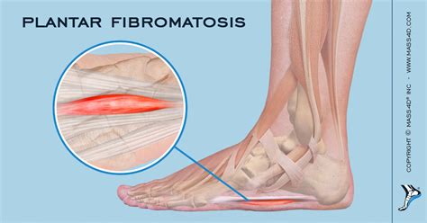 What Is Plantar Fibromatosis Mass4d® Foot Orthotics