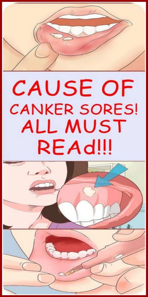 Cause Of Canker Sores All Must Read Canker Sore Causes Canker
