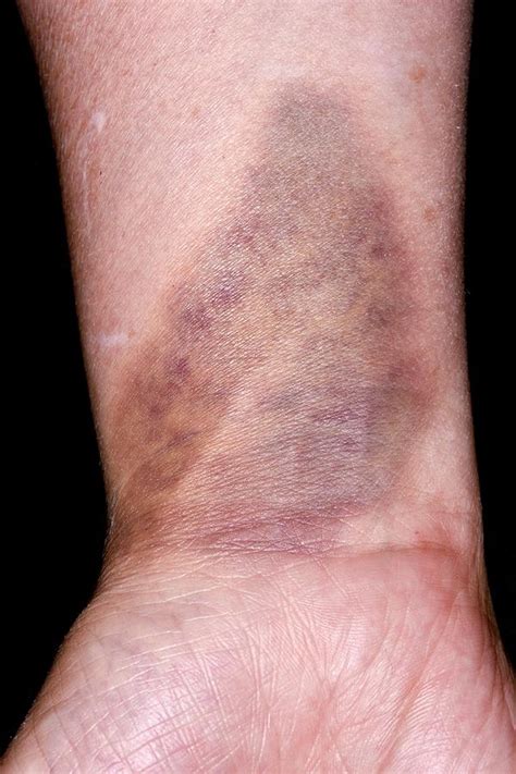 Bruise On Wrist Photograph By Dr P Marazziscience Photo Library