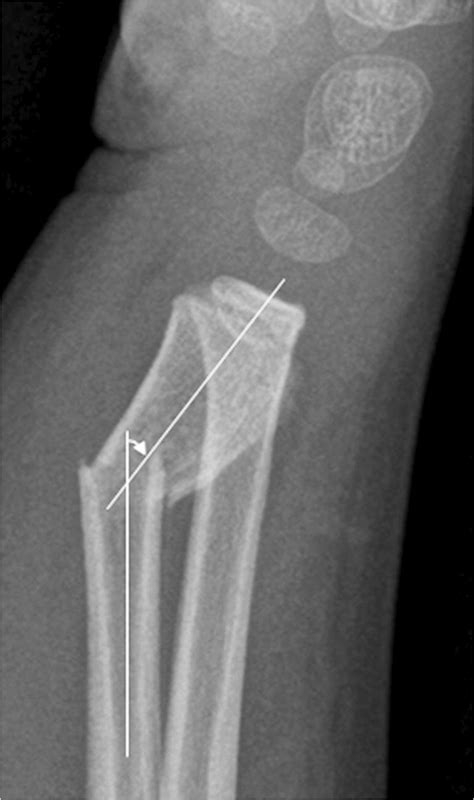 Angulated Distal Radial Fracture In A 5 Year Old Girl Lateral Wrist