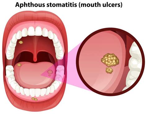 Fed Up With Mouth Sores Try These Home Remedies For Mouth Ulcers