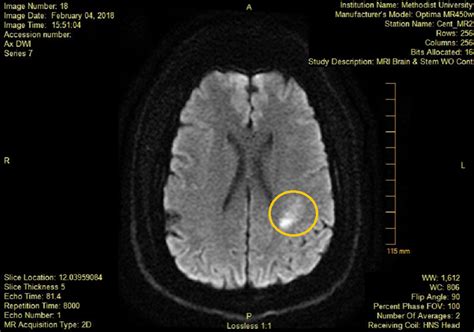Cureus Cryptogenic Stroke And Significance Of The Patent Foramen