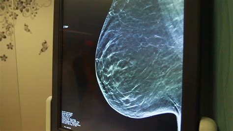 Behind The Scenes Of A Mammogram Watch