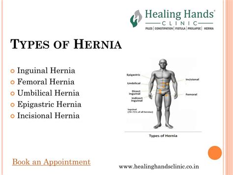 A Brief Introduction To Types Of Hernia Hernia Symptoms Epigastric