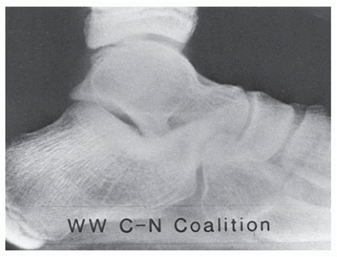 Tarsal Coalition Musculoskeletal Key