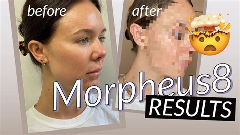 Morpheus 8 Results Before And After Postpartum Glow Up Plan Youtube