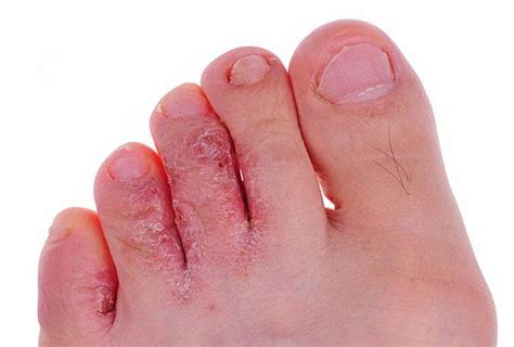 Toes Rash Pictures Photos