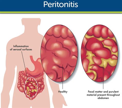 Peritonitis Bacterial Peritonitis Causes Signs Symptoms And Treatment