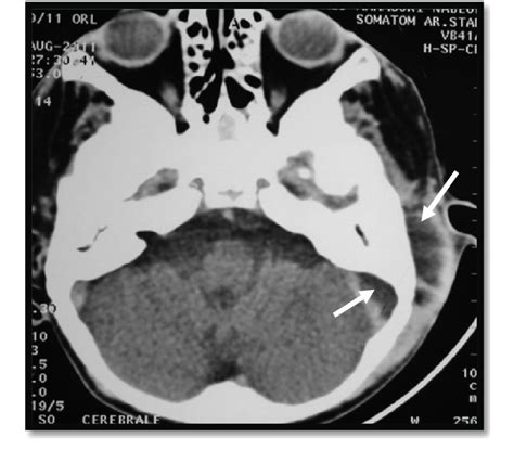 Ct Scan Axial Plane Revealed Subperiosteal Abscess And Lateral Sinus