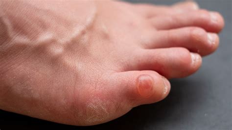 All You Need To Know About Pinky Toe