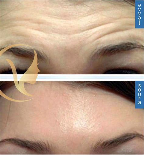 Forehead Lines Botox Before And After Facelift Info Prices Photos