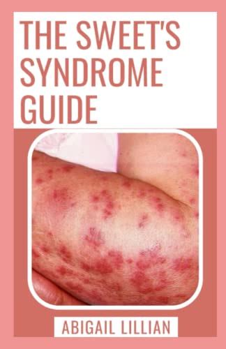 the sweet s syndrome guide the complete guide to treatment causes and management with easy to