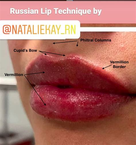 Lip Fillers Los Angeles Russian Lip Technique Best Injections Options