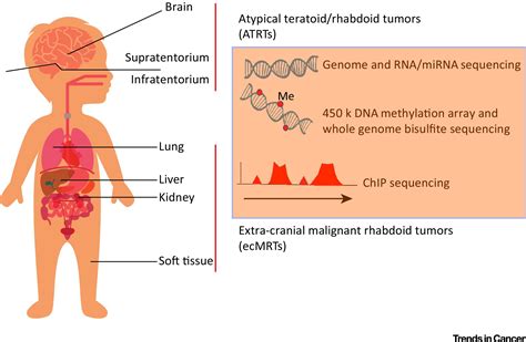 A Molecular Take On Malignant Rhabdoid Tumors Trends In Cancer
