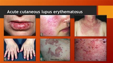 Lupus Erythematosus Slide Share