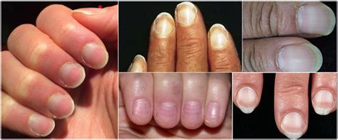 Nail Signs Apparent Leukonychia 表相白甲 Tangs Clinical Tcm