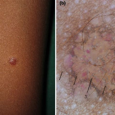 Angiokeratoma Histopathological Examination Multiple Ectatic