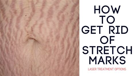 How To Get Rid Of Stretch Marks Laser Treatment Options Youtube