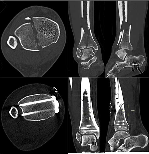 Pilon Fractures A New Classification System Based On Ct Scan Injury