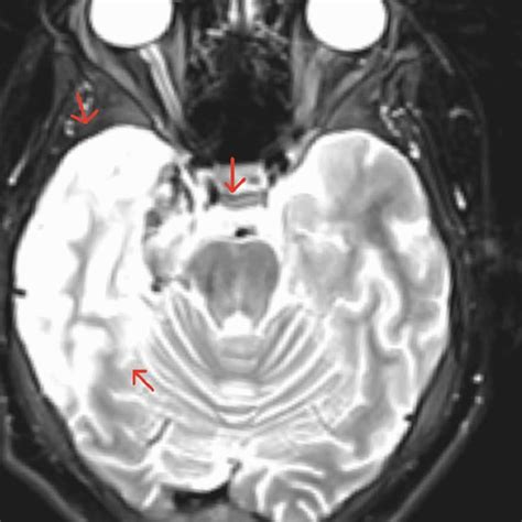 Mri Brain With Contrast In A T2 Weighted Axial View The Axial View