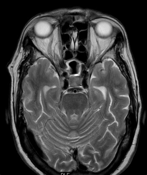 Early Cavernous Sinus Thrombosis Gd Mri Sumers Radiology Blog