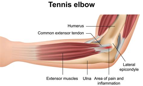 The tendons may also become thickened and have a hard time moving through the swollen covering. Tendinopathy (medial, lateral elbow) - Melbourne Hand Therapy