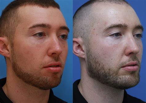 Facial Implants Before And After 10