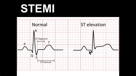 Types Of St Elevation