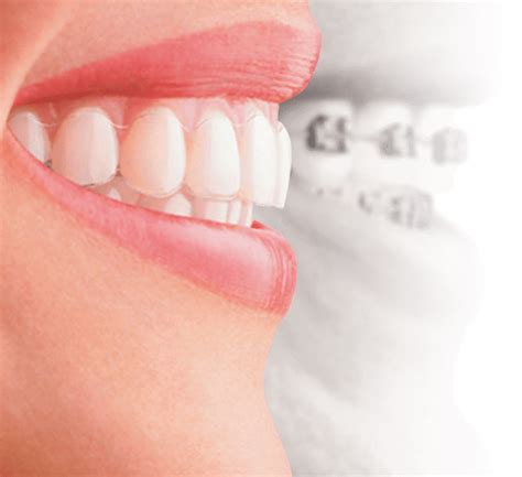 Invisalign Dentist Waterloo Dentist Erbsville Dental