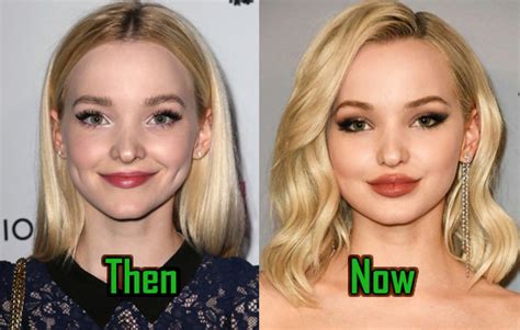 Dove Cameron Plastic Surgery Lips Injection Before And After Celebritysurgeryicon