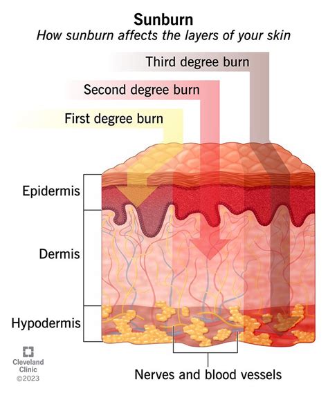 Sunburn Symptoms And Treatment