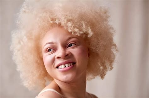 Can Albino People Dye Their Hair 3 Factors To Focus Vaunte