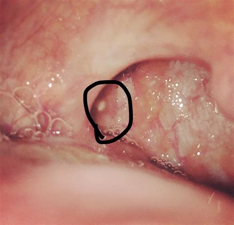 White Dot At Back Of Throats Where Tonsil Used To Be Oral And Dental