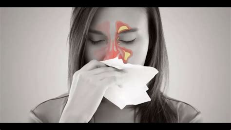 Sinusitis CrÓnica Causas SÍntomas Y Tratamiento Youtube