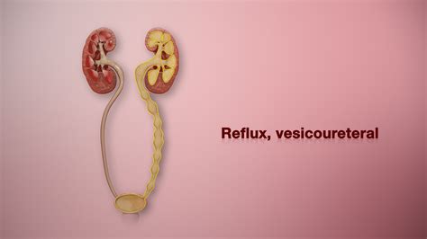 vesicoureteral reflux vur shown using 3d medical animation